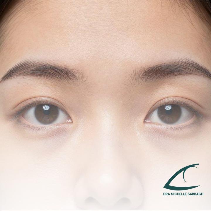 Olhos saltados podem ser problema de tireoide: entenda causas e cuidados urgentes